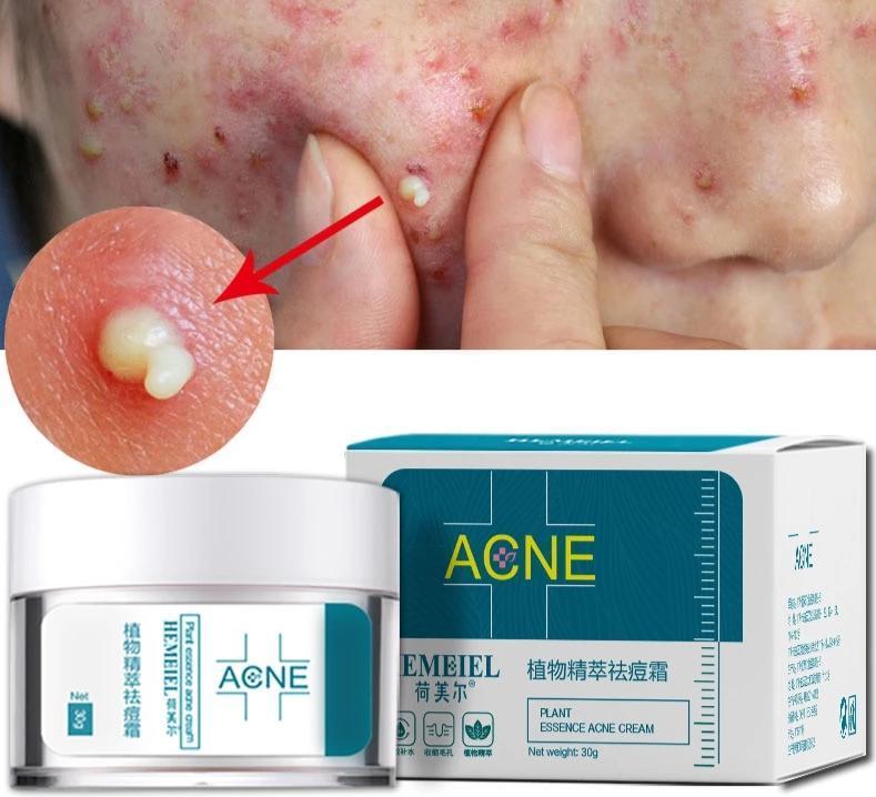 Acne Cream for Pimples & Scars – Fast Acting Spot Treatment with Soothing Formula (30g)