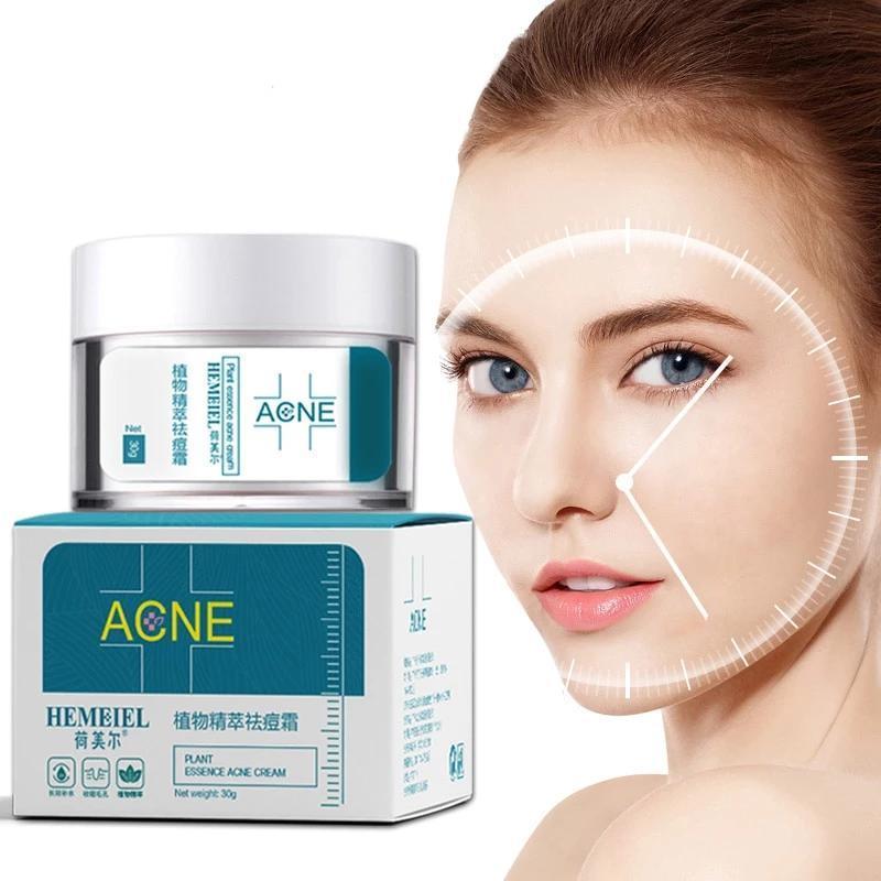 Acne Cream for Pimples & Scars – Fast Acting Spot Treatment with Soothing Formula (30g)