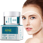 Acne Cream for Pimples & Scars – Fast Acting Spot Treatment with Soothing Formula (30g)